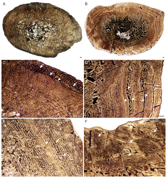 Figure 4: Transverse sections of the bone histology of Lystrosaurus maccaigi , Age Class II. (A) NMQR 796a tibia showing an infilled medullary cavity. (B) NMQR 4095 femur showing a gradual transition from medullary cavity to compact cortex. (C) NMQR 796a tibia showing enlarged canals (arrows) and an annulus (arrowhead). (D) NMQR 4095 femur showing enlarged canals (arrows) and two annuli (arrowheads). (E) NMQR 3648 humerus showing large canals (arrows) and a LAG (arrow). (F) NMQR 4095 femur showi